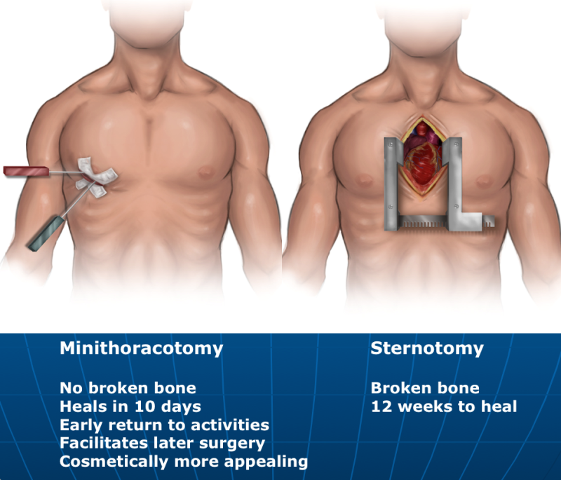 keyhole-aortic-valve-surgery-is-safe-and-effective-the-keyhole-heart