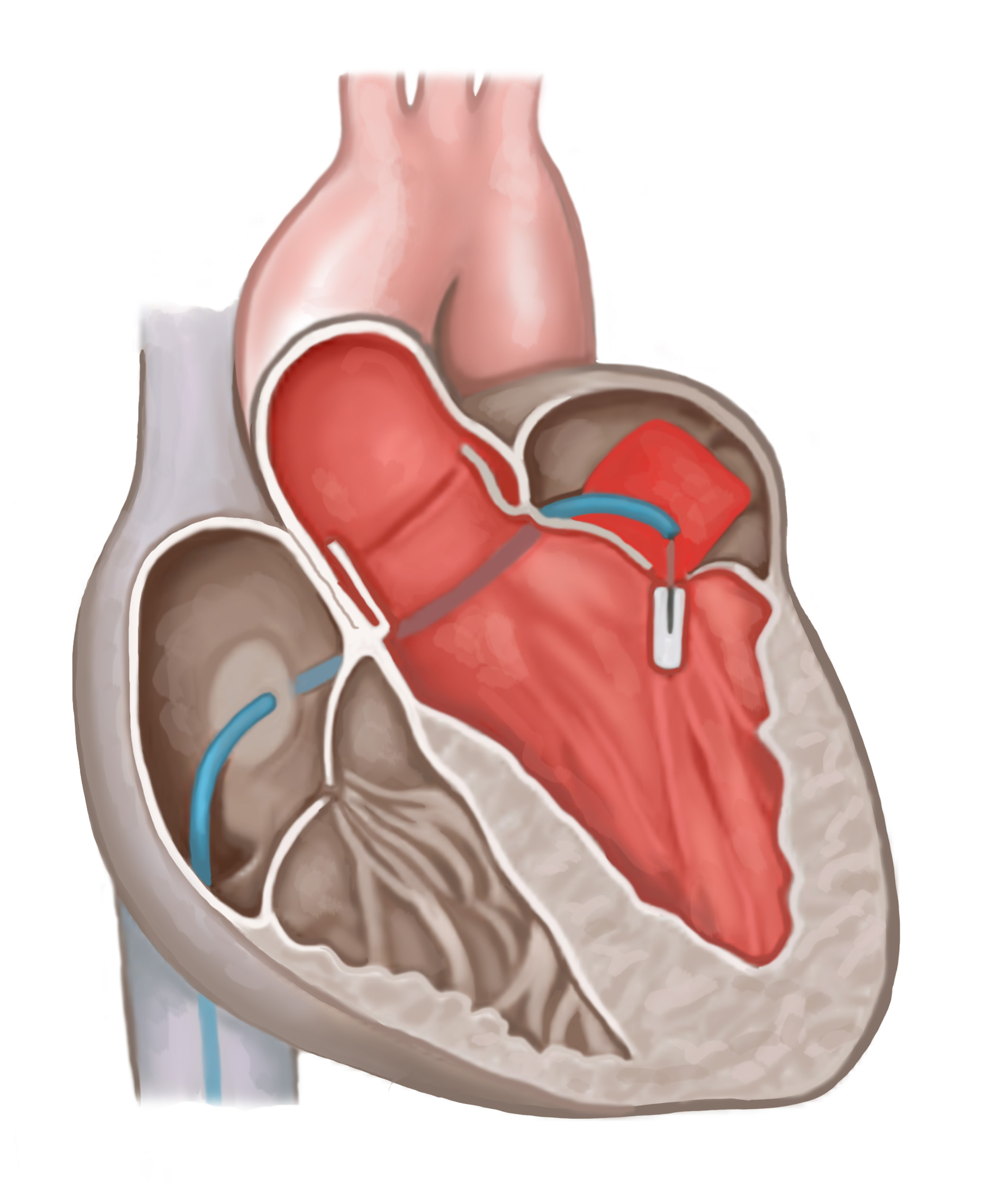 mitral-regurgitation-the-keyhole-heart-clinic