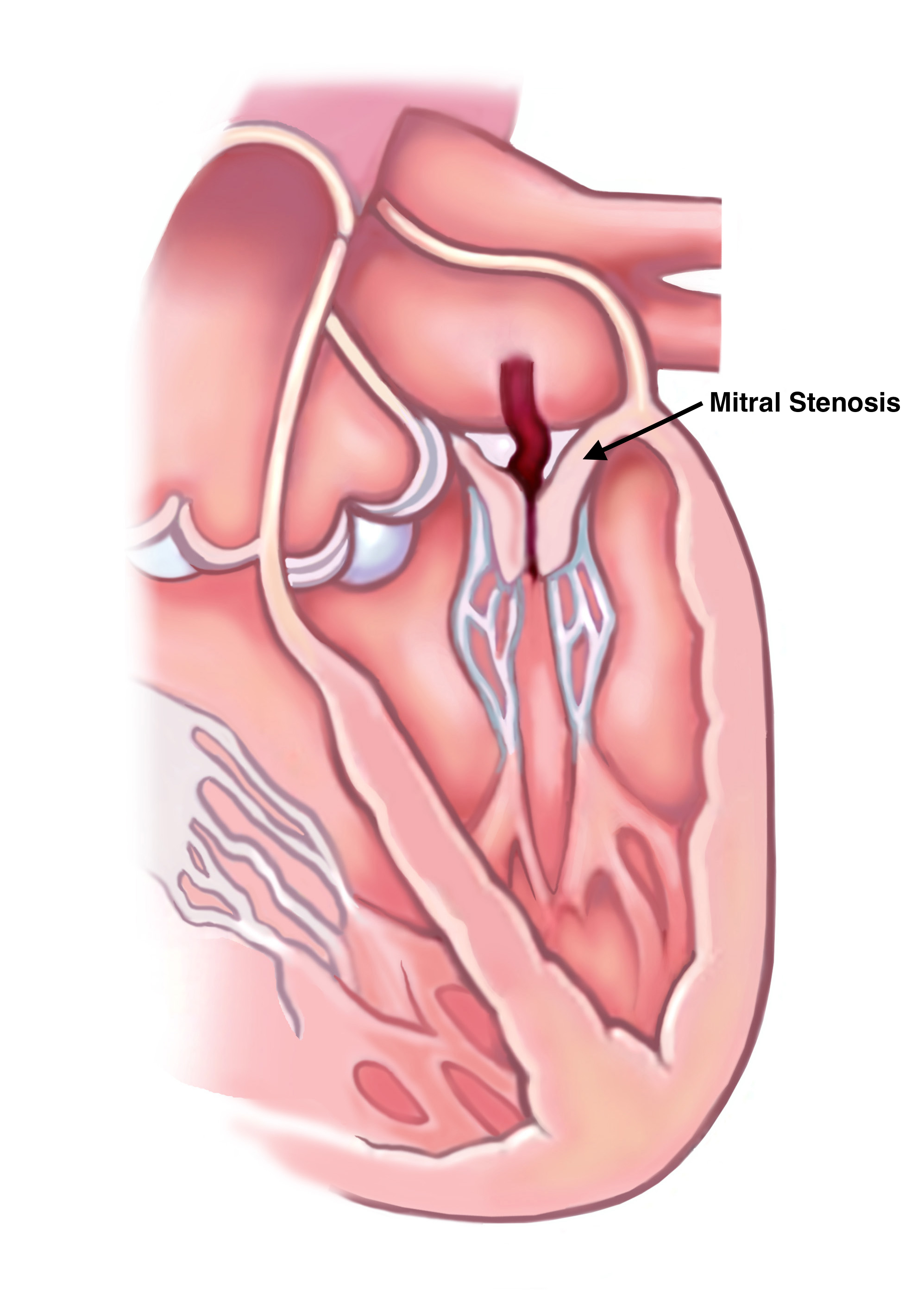 Mitral Stenosis The Keyhole Heart Clinic