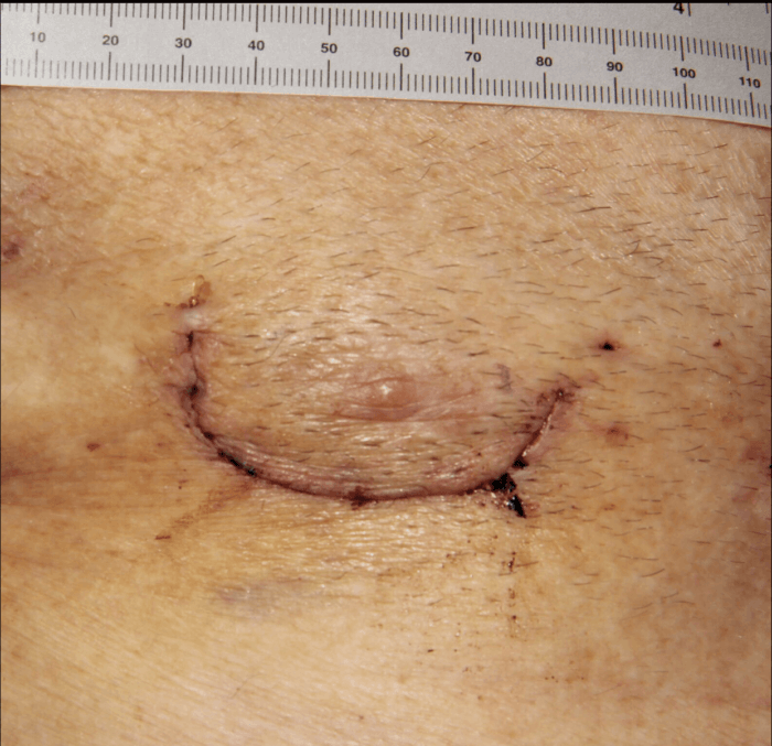 Breastbone incision