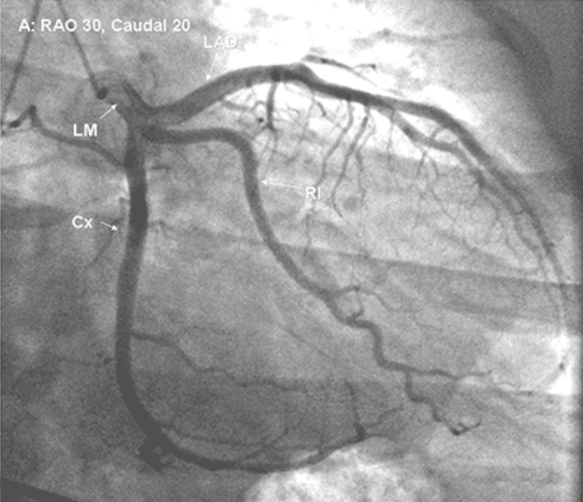 Коронарография фото с описанием патологии