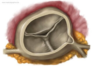 Aortic Root Dilation