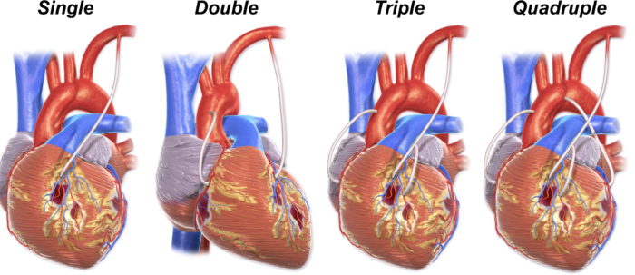 What Is A Coronary Artery Bypass Graft Learn More Online