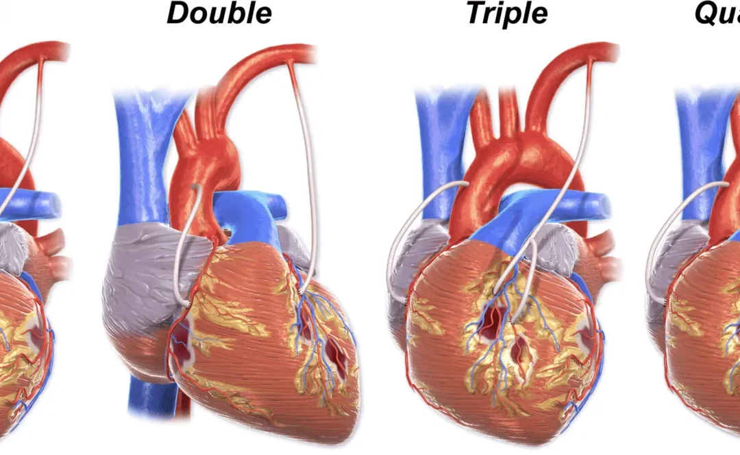 Minimally Invasive Direct Coronary Artery Bypass (MIDCAB): A Revolutionary Approach to Heart Surgery