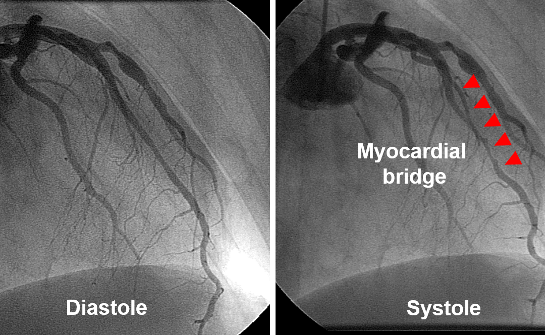 Myocardial Bridge: A Hidden Cause of Heart Symptoms You Should Know