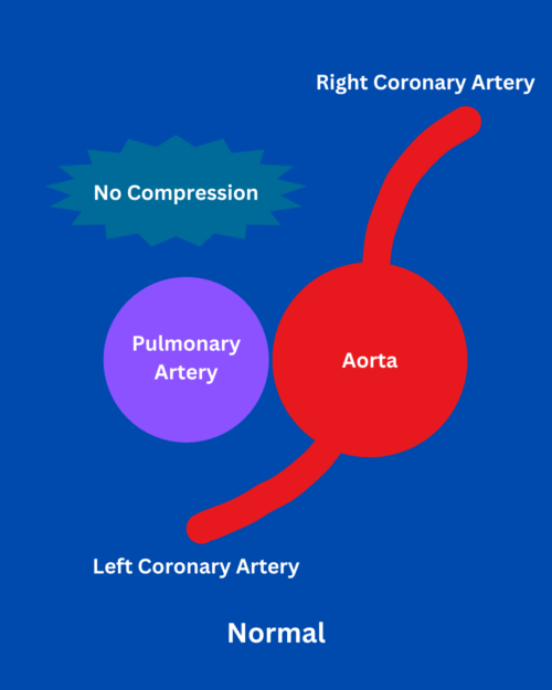 The Danger of Anomalous Coronary Artery Anatomy - The Keyhole Heart Clinic