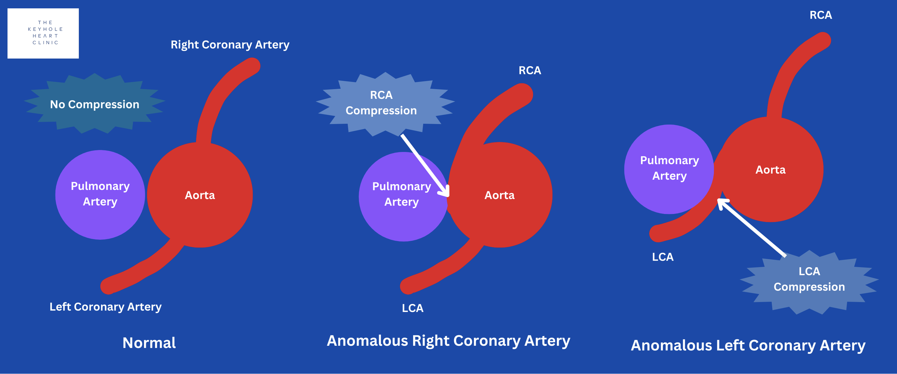 The Danger of Anomalous Coronary Artery Anatomy - The Keyhole Heart Clinic